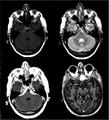 Abscopal effect leading to complete disappearance of extensive meningiomatosis after gamma knife radiosurgery: Case report